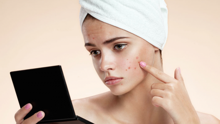 How To Remove Pimple Marks Naturally