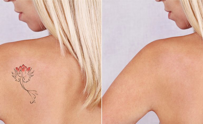 How To Remove A Permanent Tattoo